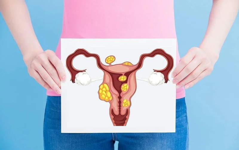 水蛭素、子宫肌瘤、子宫纤维瘤