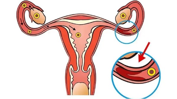 如何证明输卵管是通的？输卵管堵塞应该怎么办？