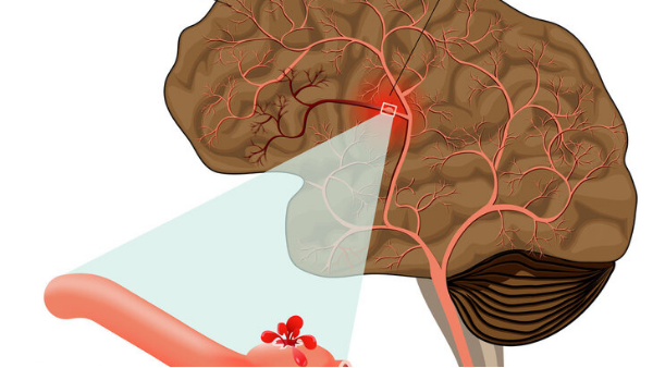 血压高指标到多少，就会发生脑出血？