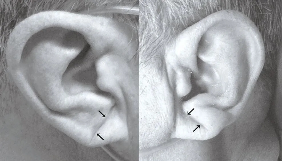 “耳朵褶皱”就是冠心病迹象？存在这7大症状的人心脏更危险