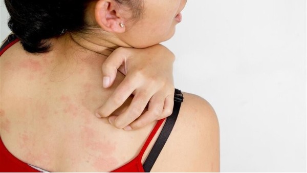 湿疹反复性发作瘙痒难耐，不妨用这5个方法