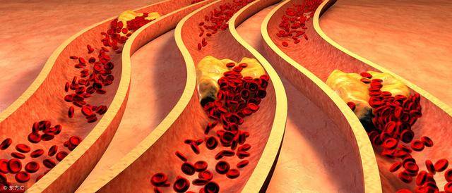 不明原因的心绞痛有可能是微血管病变