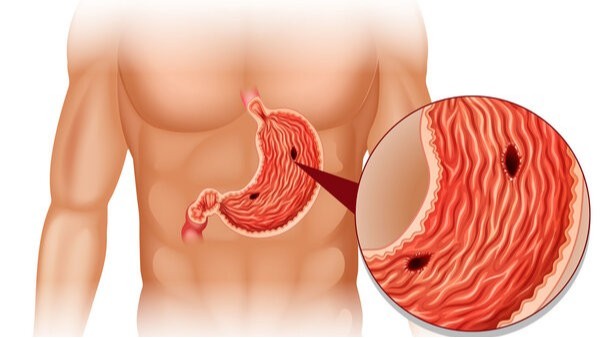 患上胃溃疡该怎么吃？注意这3点